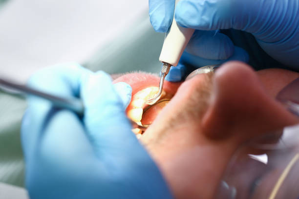 Best Emergency Treatment for Dental Infections or Abscesses in Indian Springs, GA