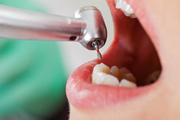 Best Emergency Dental Care for Broken or Chipped Teeth in Indian Springs, GA
